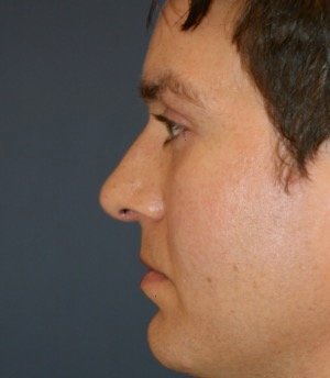 Rhinoplasty 208 - after - side