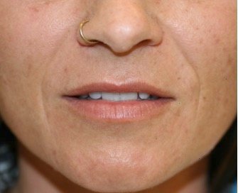 Nasal-Labial Folds Filler 101 - before - front