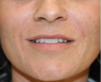 Nasal-Labial Folds Filler 101 - after - front