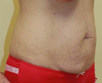 Tummy Tuck Case 26 - before - oblique