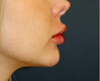 Chin Implant 203 - before - front