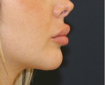 Chin Implant 203 - after - front