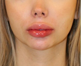Chin Implant 203 - before - oblique