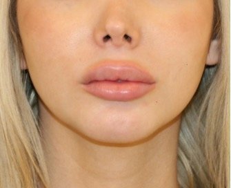 Chin Implant 203 - after - oblique