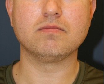 Chin Implant 205 - before - front