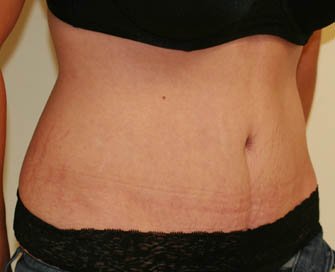 Tummy Tuck Case 26 - after - oblique