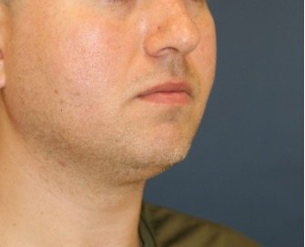 Chin Implant 205 - before - oblique