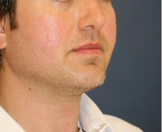Chin Implant 205 - after - oblique