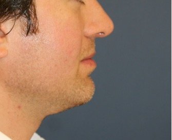 Chin Implant 205 - after - side