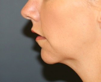 Chin Implant 206 - before - front