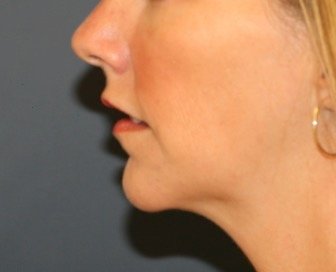 Chin Implant 206 - after - front