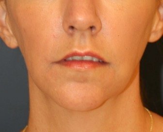 Chin Implant 206 - before - oblique