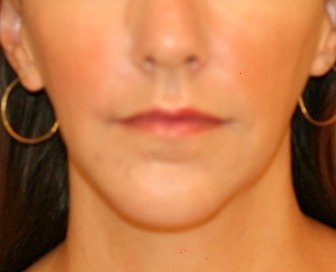 Chin Implant 206 - after - oblique