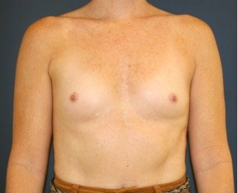 Natural Breast Augmentation 012 - before - front