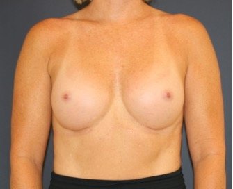 Natural Breast Augmentation 012 - after - front