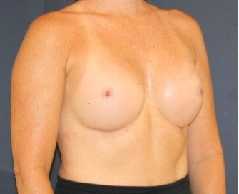 Natural Breast Augmentation 012 - after - oblique