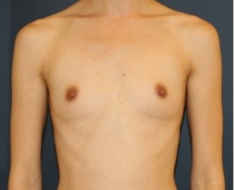 Breast Augmentation 149 - before - front