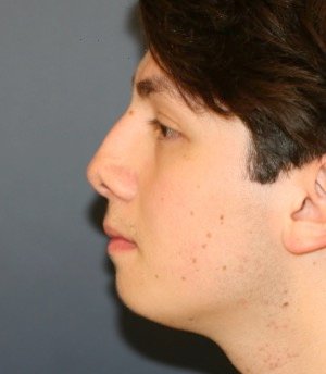Rhinoplasty 209 - before - front