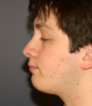 Rhinoplasty 209 - after - front