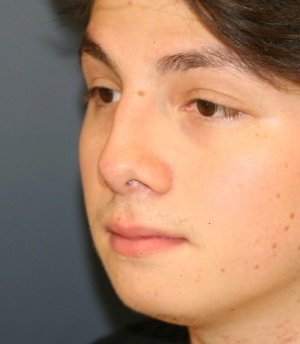 Rhinoplasty 209 - before - oblique