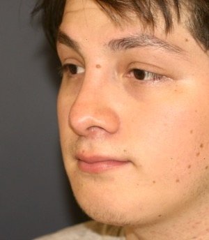 Rhinoplasty 209 - after - oblique