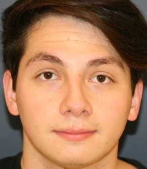 Rhinoplasty 209 - before - side