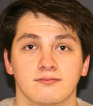 Rhinoplasty 209 - after - side