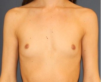 Natural Breast Augmentation 013 - before - front