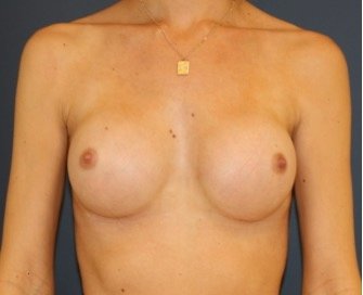 Natural Breast Augmentation 013 - after - front