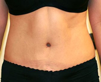Tummy Tuck Case 8 - after - front