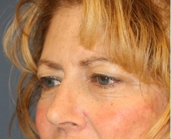 Browlift Sub-Q temporal - before - oblique