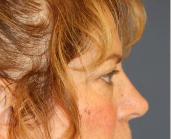 Browlift Sub-Q temporal - before - side