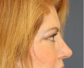 Browlift Sub-Q temporal - after - side