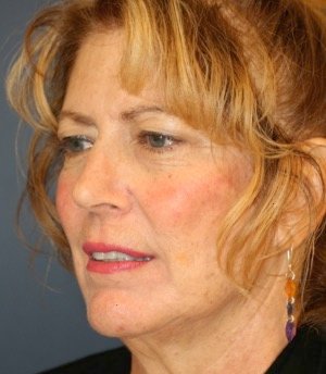 Facelift 104 - before - oblique
