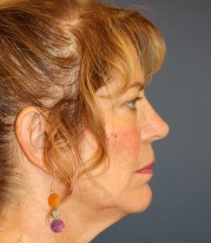 Facelift 104 - before - side