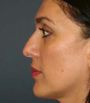 Rhinoplasty 210 - before - front