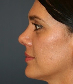 Rhinoplasty 210 - after - front