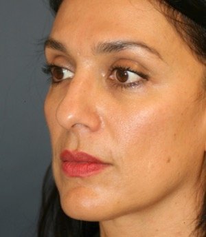 Rhinoplasty 210 - before - oblique