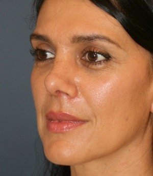Rhinoplasty 210 - after - oblique