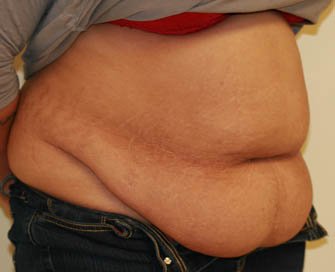 Tummy Tuck Case 28 - before - oblique
