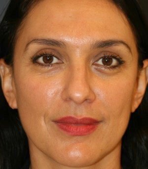 Rhinoplasty 210 - before - side
