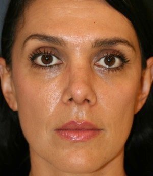 Rhinoplasty 210 - after - side