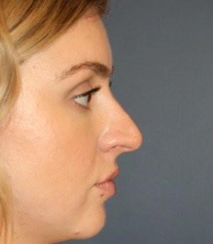 Rhinoplasty 211 - before - front