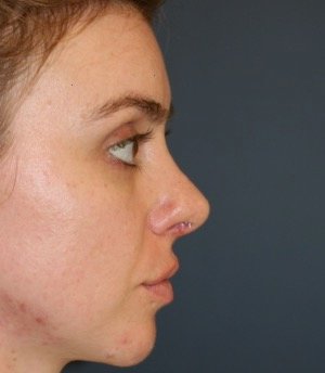 Rhinoplasty 211 - after - front