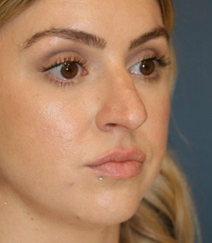 Rhinoplasty 211 - before - oblique
