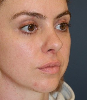 Rhinoplasty 211 - after - oblique