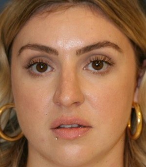 Rhinoplasty 211 - before - side