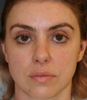 Rhinoplasty 211 - after - side