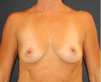 Breast Augmentation 152 - before - front