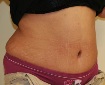 Tummy Tuck Case 28 - after - oblique